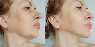 Isle of dogs Face thread lift