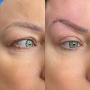 Face thread lift South woodford