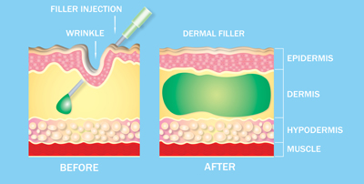 Aldgate east Dermal filler forehead