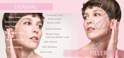 Dermal filler Roman road