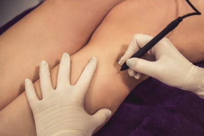 Canning town Electrology hair removal